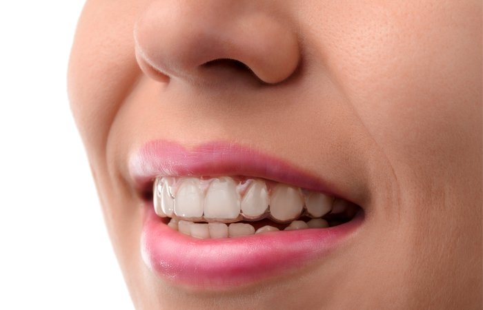 Invisalign Aberdeen